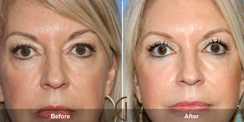 Eyelid Surgery Before & After Image