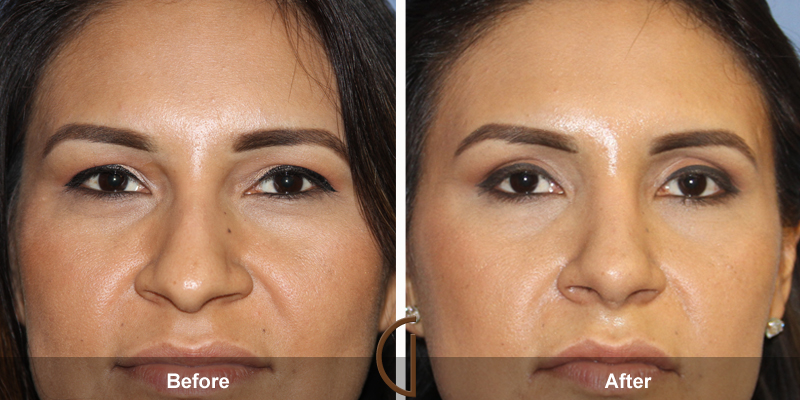 Eyelid Surgery Before & After Image