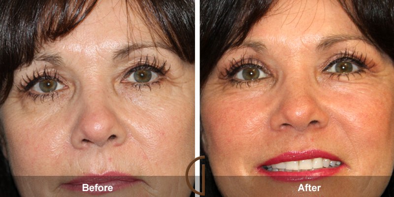 Eyelid Surgery Before & After Image