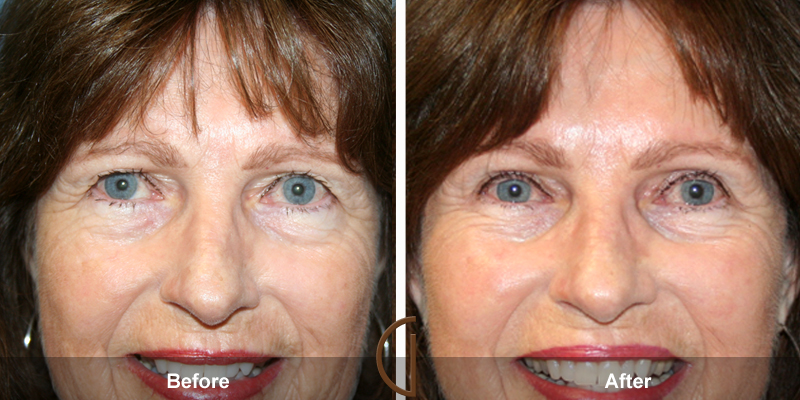 Eyelid Surgery Before & After Image