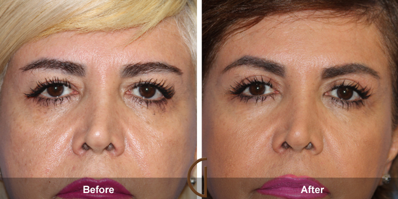 Eyelid Surgery Before & After Image