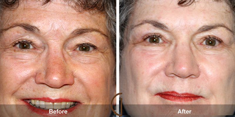 Eyelid Surgery Before & After Image