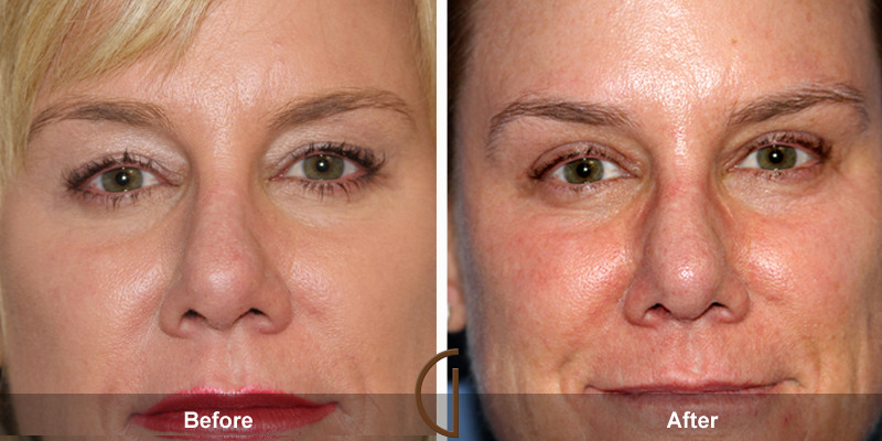 Eyelid Surgery Before & After Image