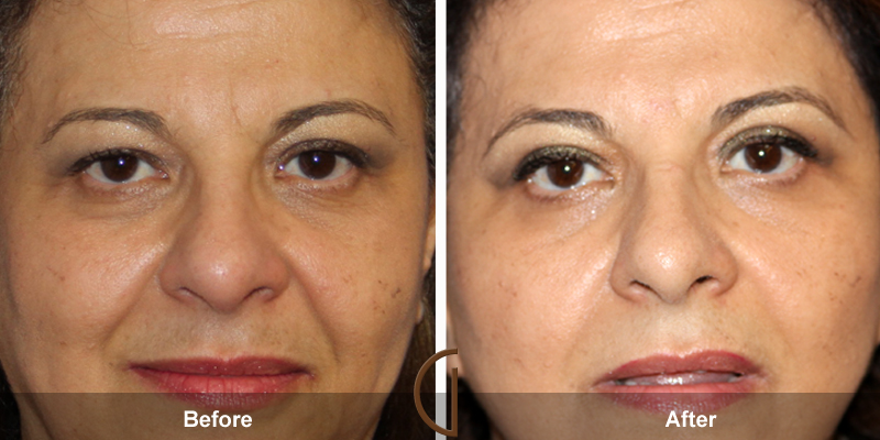 Eyelid Surgery Before & After Image