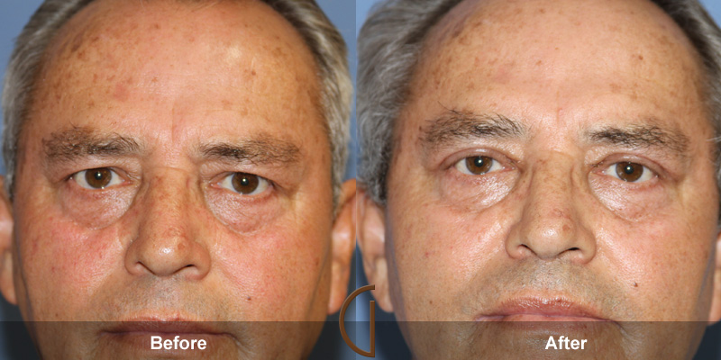 Eyelid Surgery Before & After Image