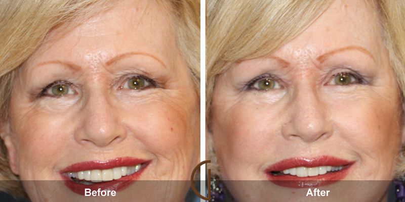 Eyelid Surgery Before & After Image