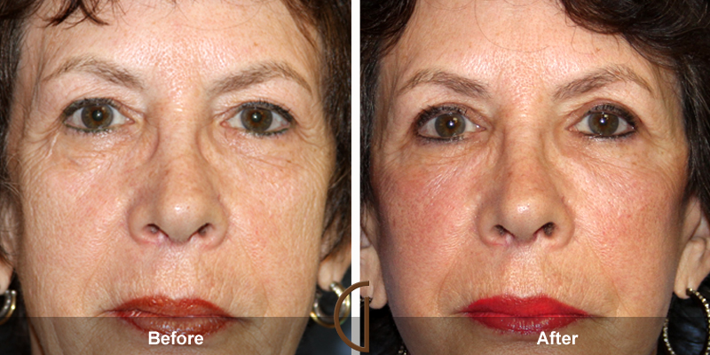 Eyelid Surgery Before & After Image