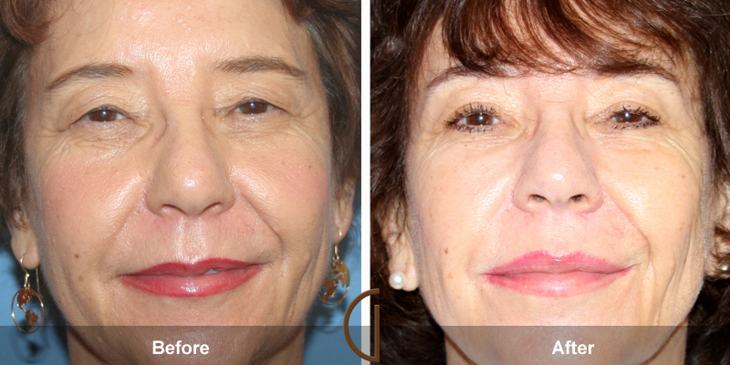 Eyelid Surgery Before & After Image