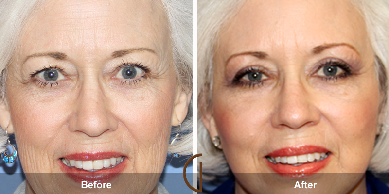 Eyelid Surgery Before & After Image