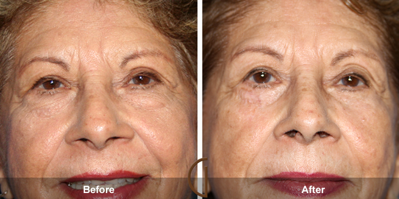 Eyelid Surgery Before & After Image