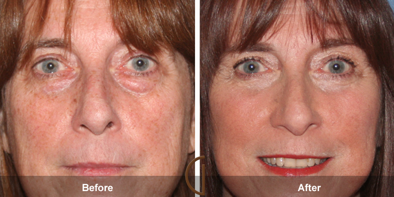 Eyelid Surgery Before & After Image