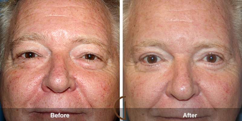 Eyelid Surgery Before & After Image