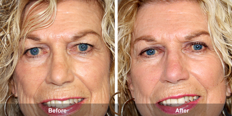 Eyelid Surgery Before & After Image