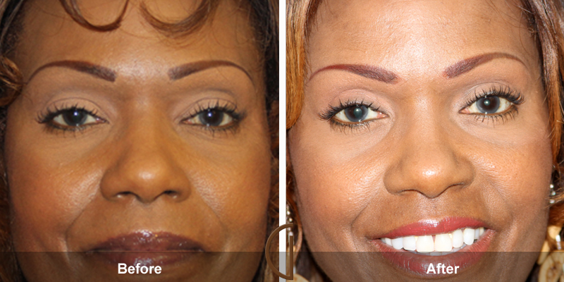 Eyelid Surgery Before & After Image