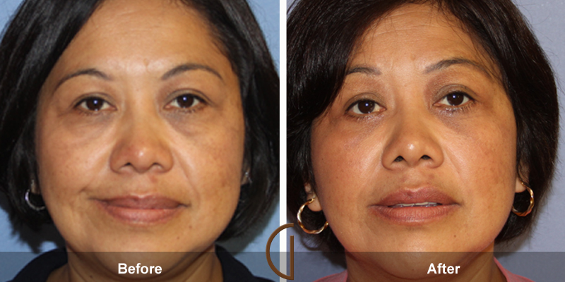 Eyelid Surgery Before & After Image