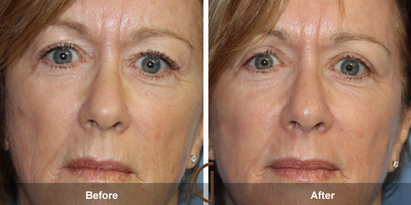 Eyelid Surgery Before & After Image