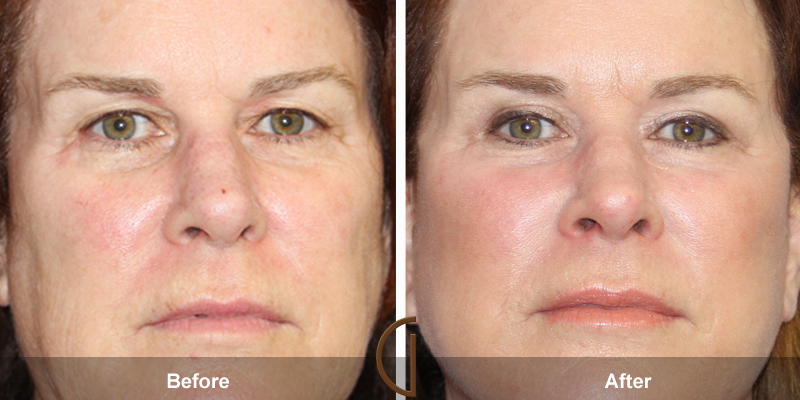 Eyelid Surgery Before & After Image