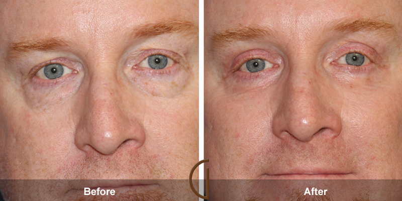 Eyelid Surgery Before & After Image