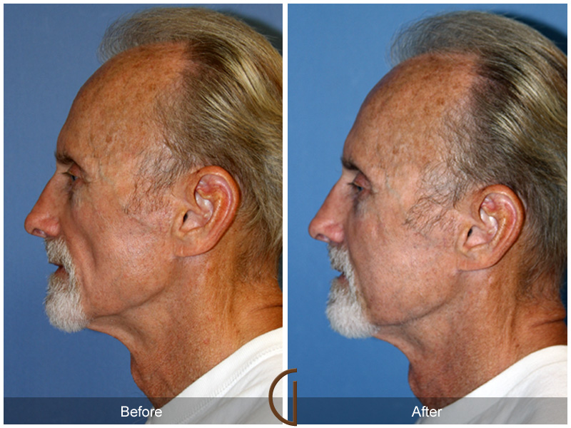 Fat Grafting Before & After Image