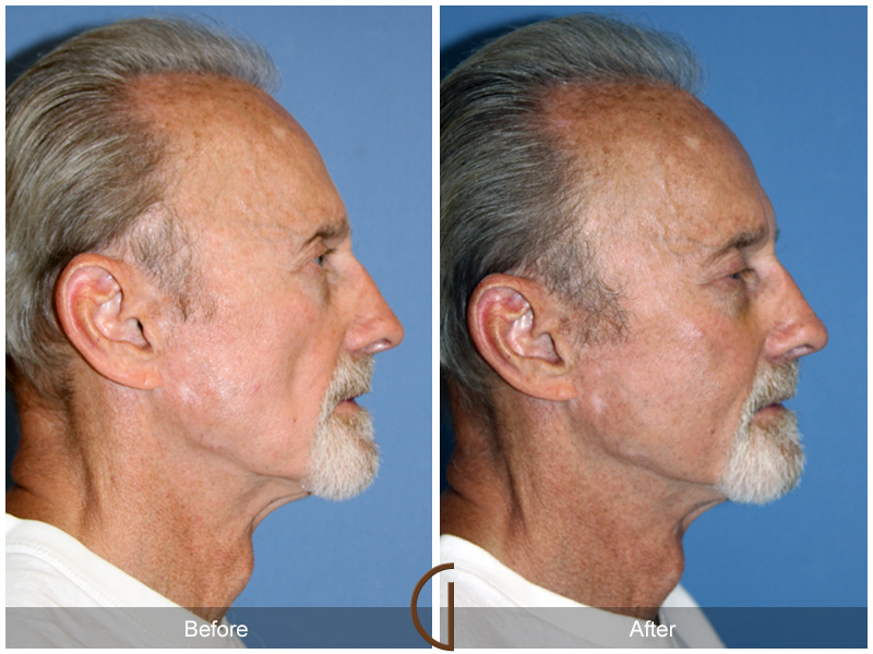 Fat Grafting Before & After Image