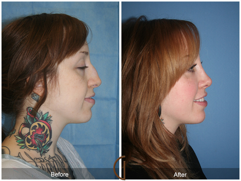 Fat Grafting Before & After Image