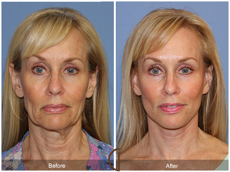Female Facelift  Before & After Image