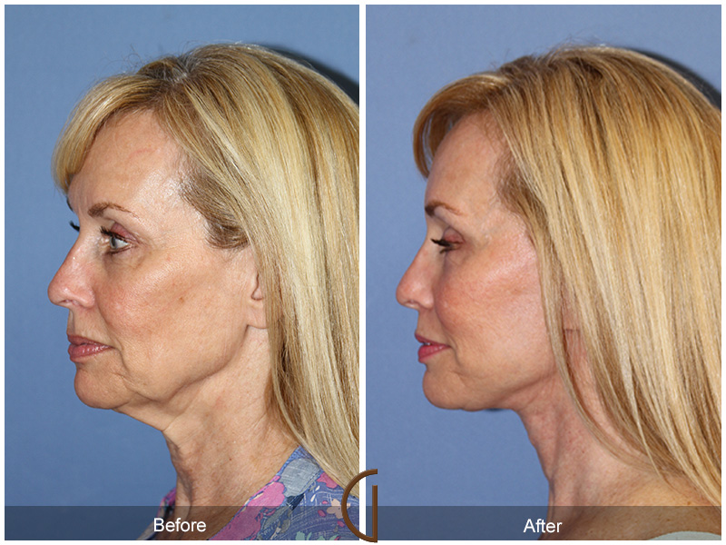 Female Facelift  Before & After Image