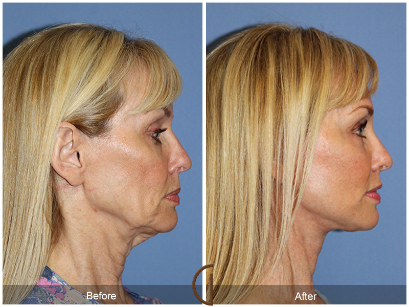 Female Facelift  Before & After Image