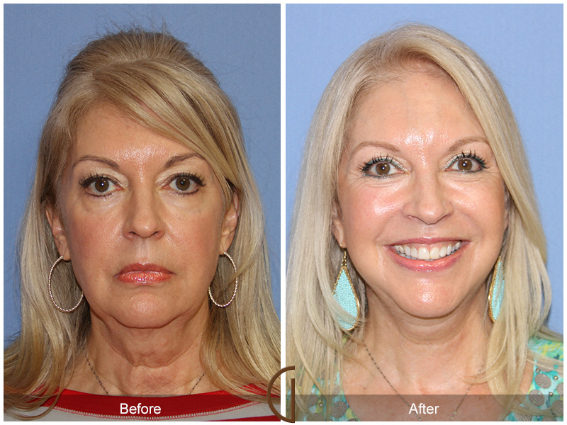 Female Facelift  Before & After Image