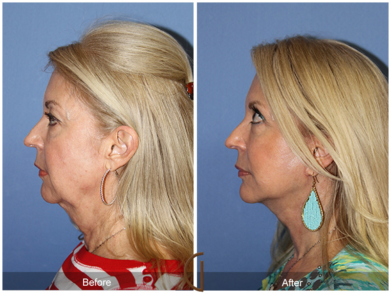 Female Facelift  Before & After Image