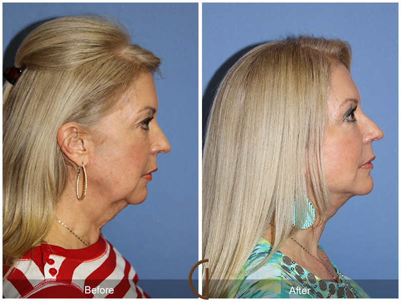 Female Facelift  Before & After Image