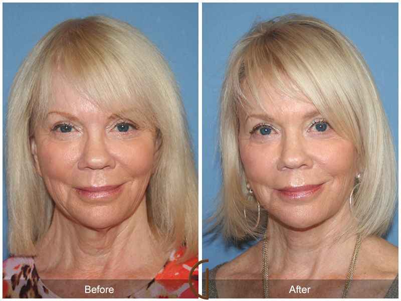 Female Facelift  Before & After Image