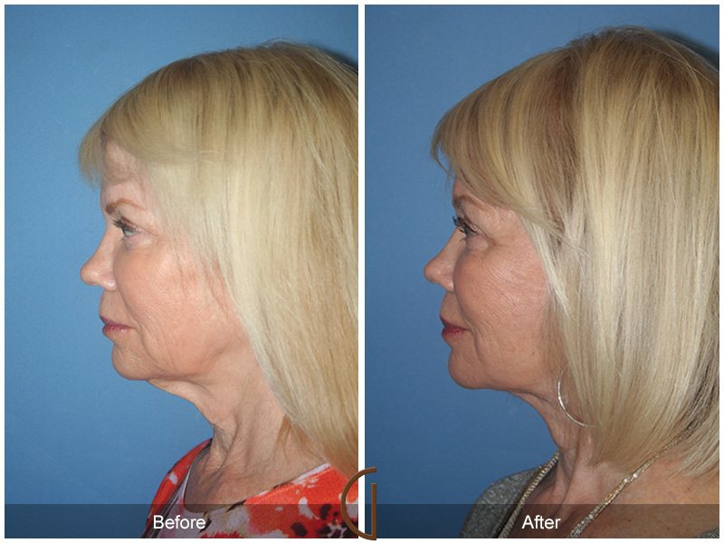 Before and after gallery for female facelift patient 3