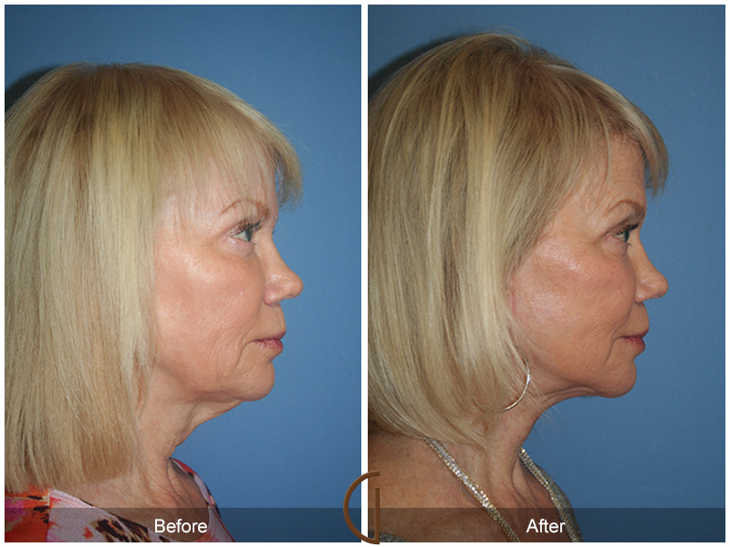 Female Facelift  Before & After Image