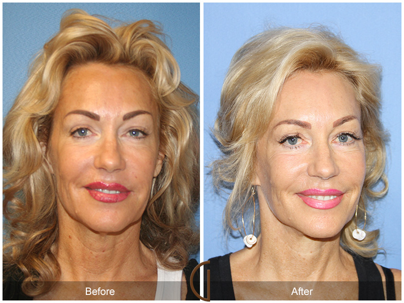 Female Facelift  Before & After Image