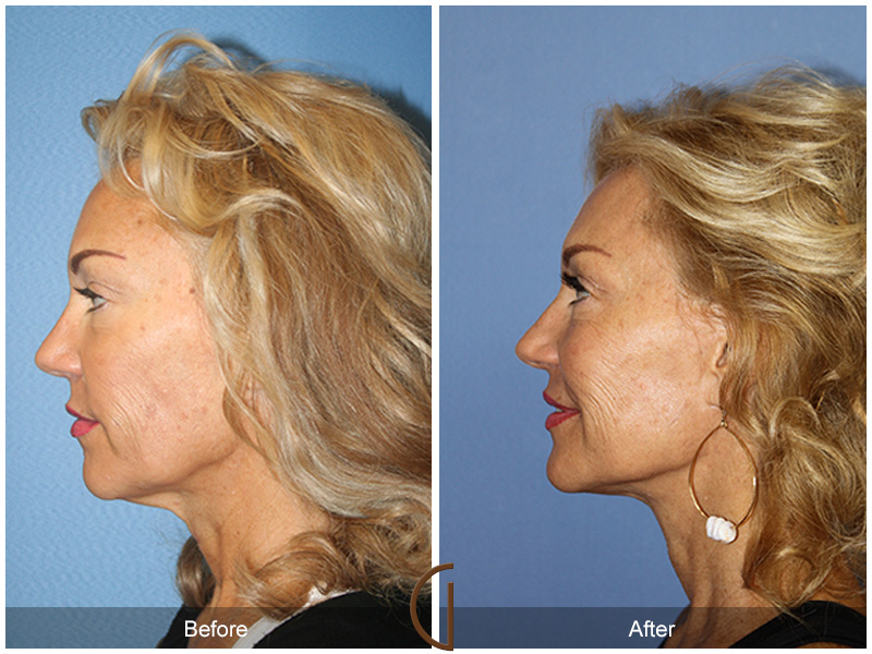 Female Facelift  Before & After Image