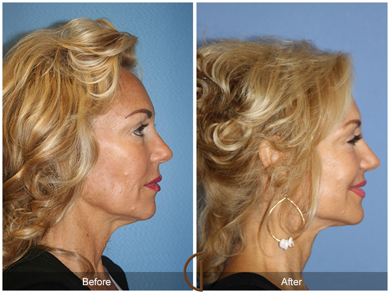 Female Facelift  Before & After Image