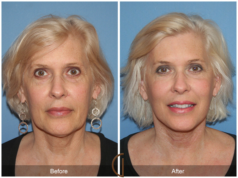 Female Facelift  Before & After Image