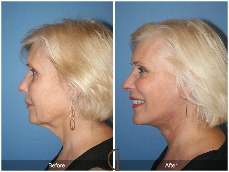 Female Facelift  Before & After Image