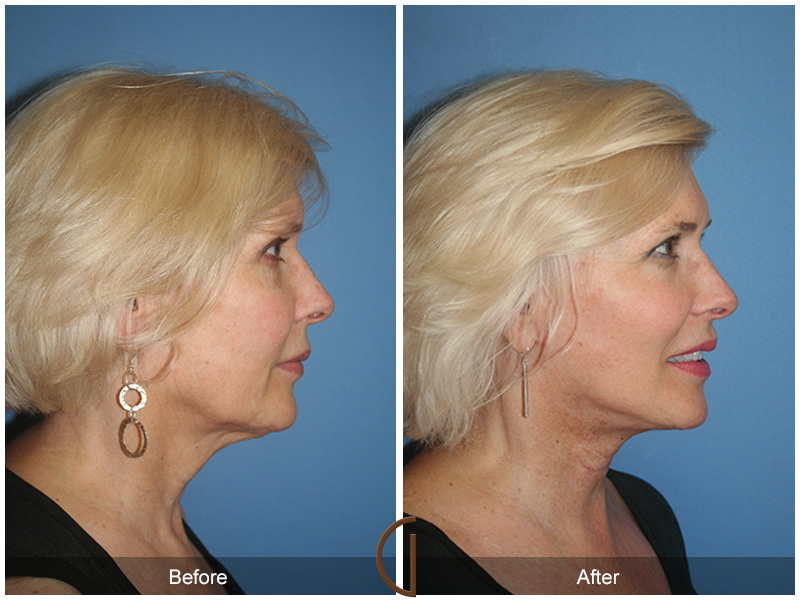 Female Facelift  Before & After Image