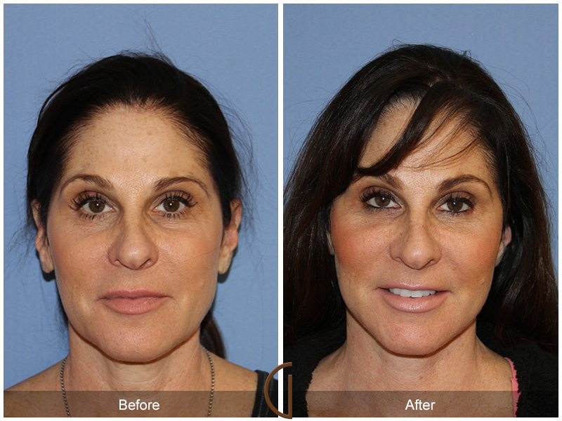 Female Facelift  Before & After Image