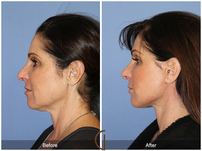 Female Facelift  Before & After Image