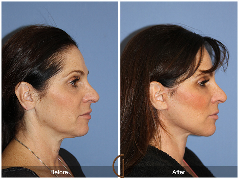 Female Facelift  Before & After Image