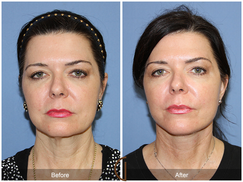 Female Facelift  Before & After Image