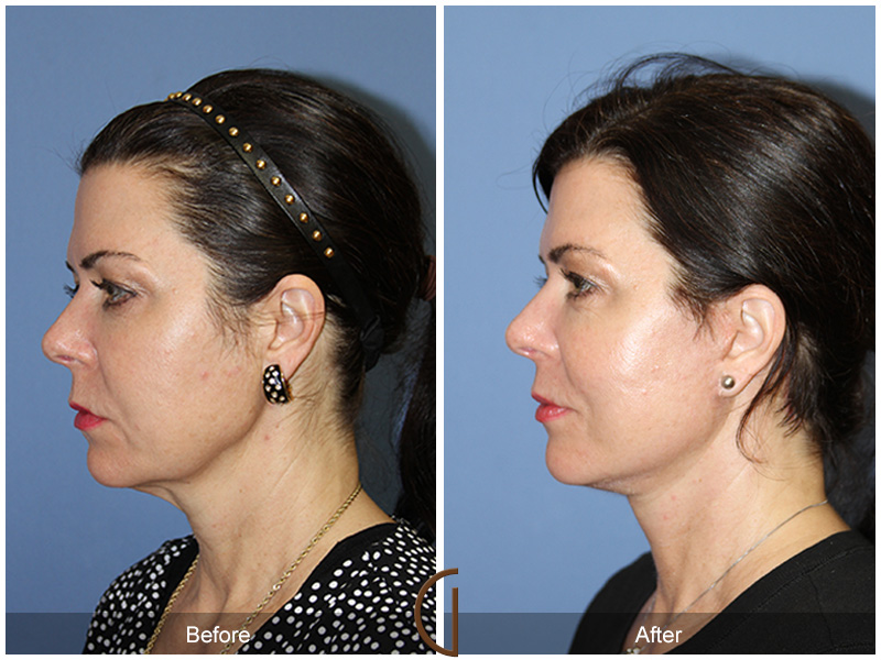 Female Facelift  Before & After Image