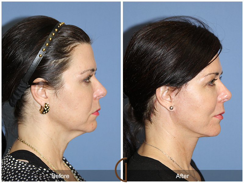 Female Facelift  Before & After Image