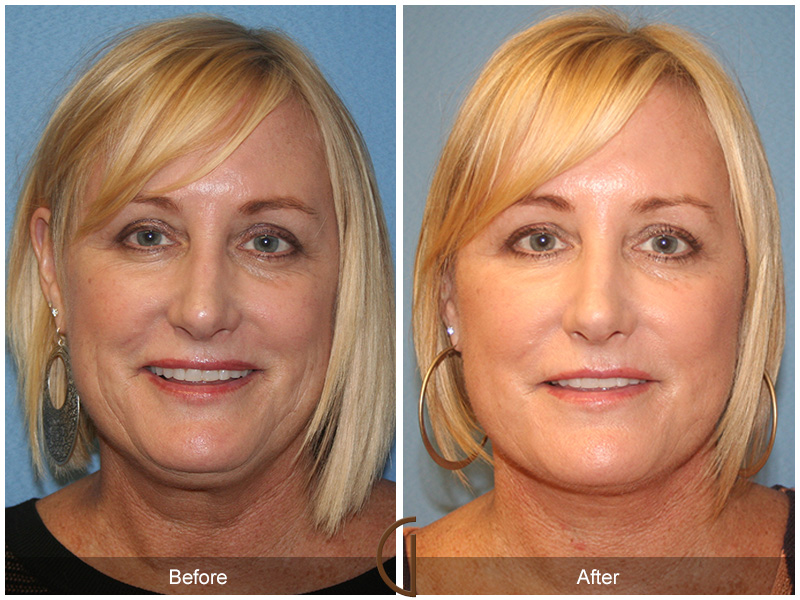 Female Facelift  Before & After Image