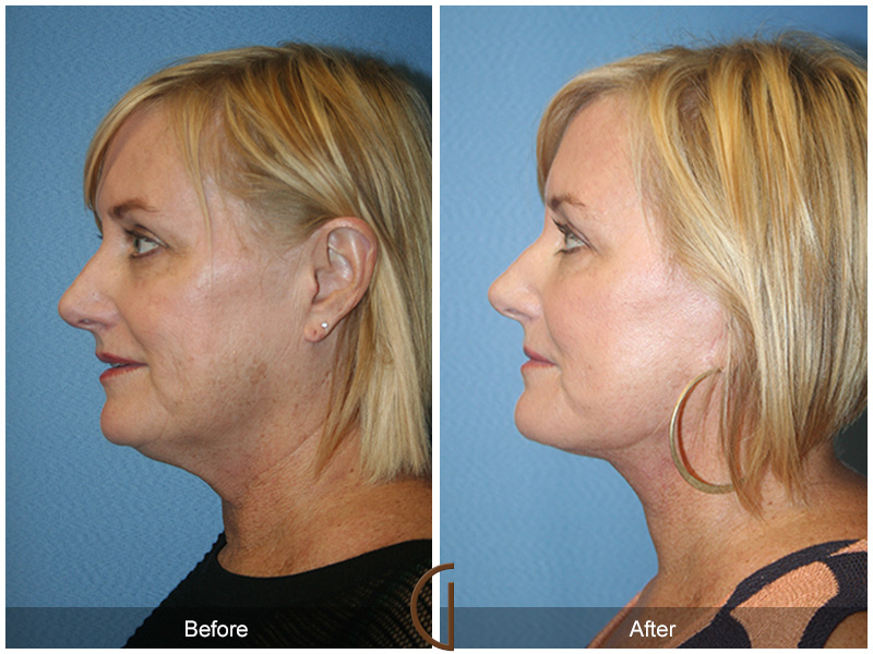 Female Facelift  Before & After Image