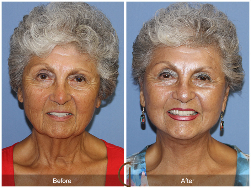 Female Facelift  Before & After Image