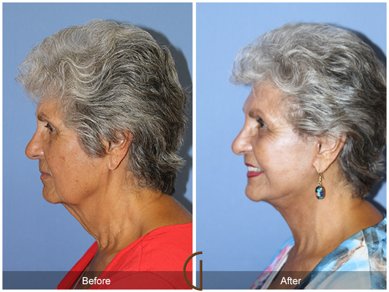 Female Facelift  Before & After Image